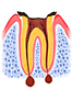 虫歯5